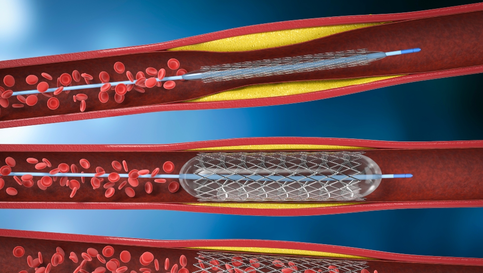 3d rendering balloon angioplasty procedure with stent in vein