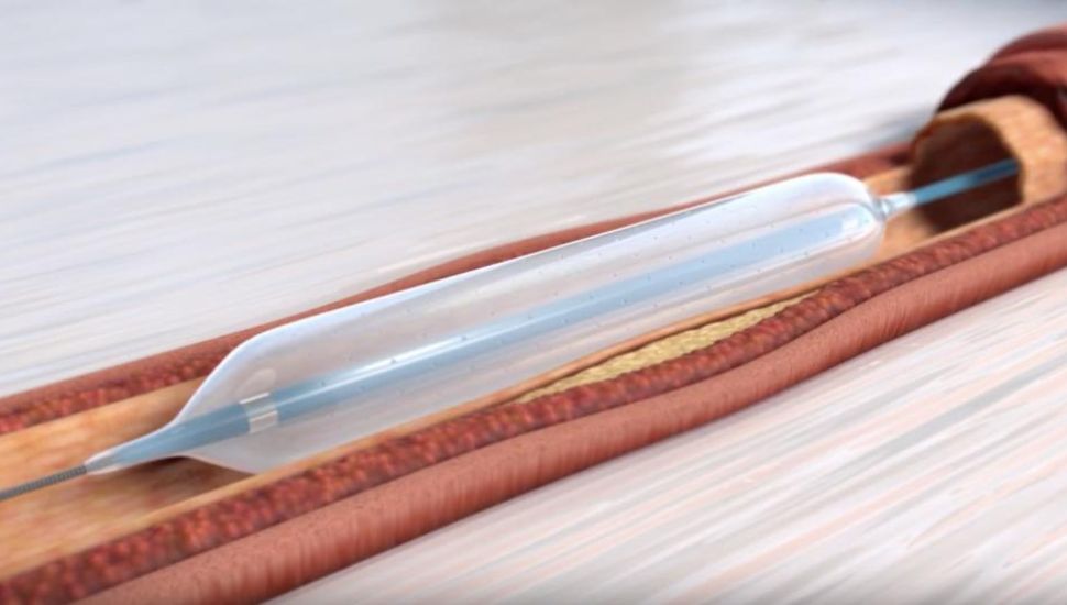 One of Orchestra BioMed's Virtue sirolimus-eluting angioplasty balloons.
